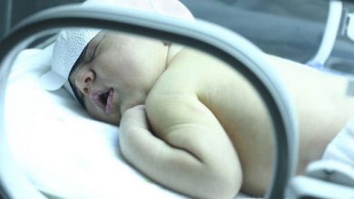 صورة علاج الصفراء عند حديثي الولادة